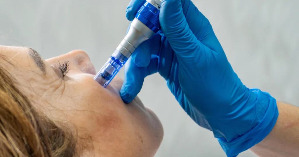 Microneedling facial treatment performed by a professional in Great Neck, NY