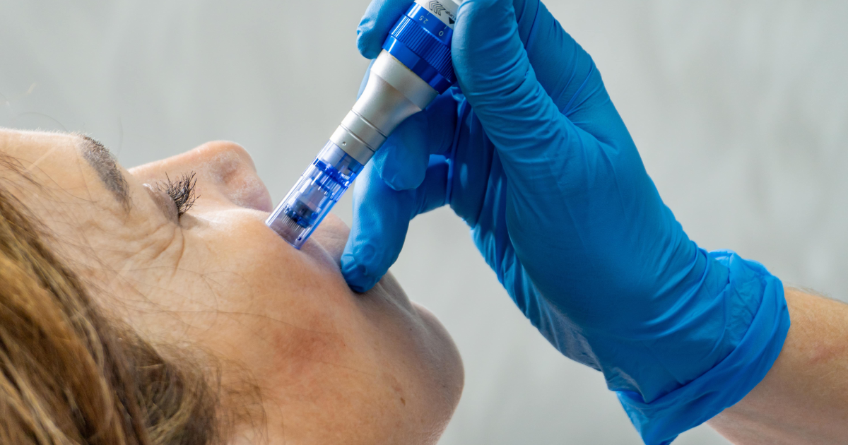 Microneedling facial treatment performed by a professional in Great Neck, NY