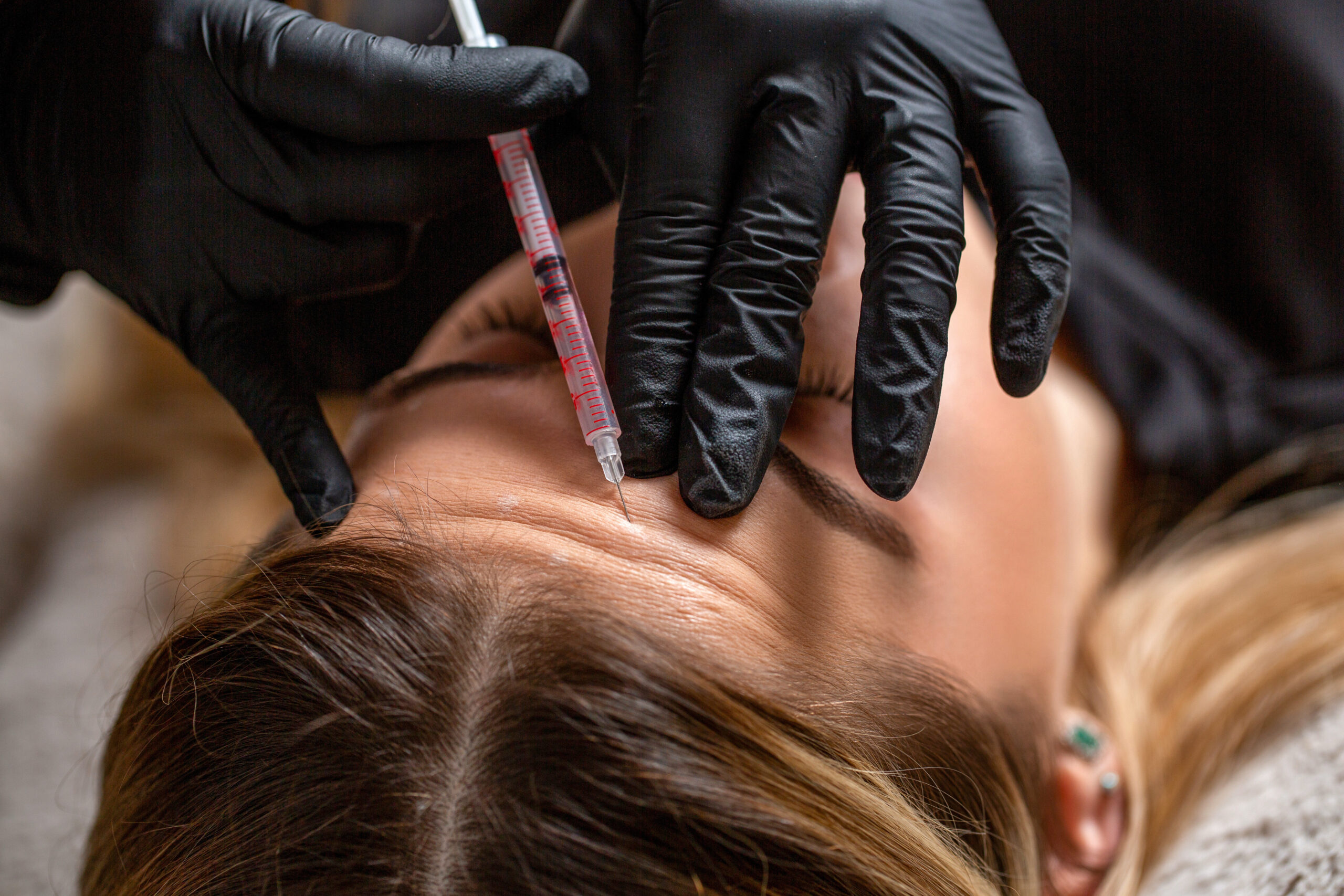 Botox Treatment In Great Neck, NYC